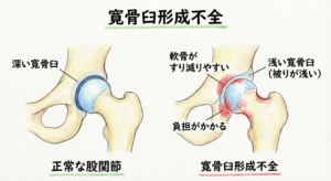 寛骨臼形成不全とは