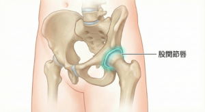 股関節唇損傷　しんもり整骨院・はり治療院