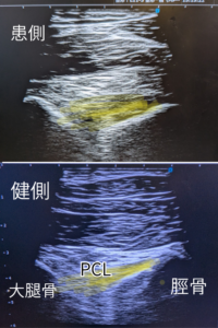 PCL　エコー　しんもり整骨院