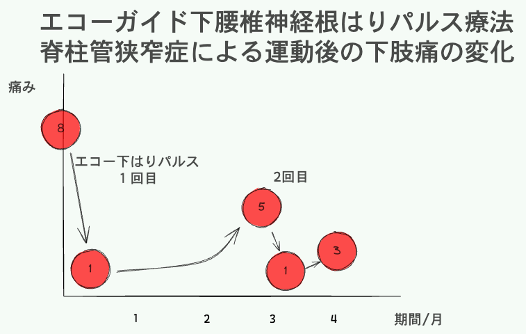 エコーガイド化腰椎神経根はり治療 狭窄症