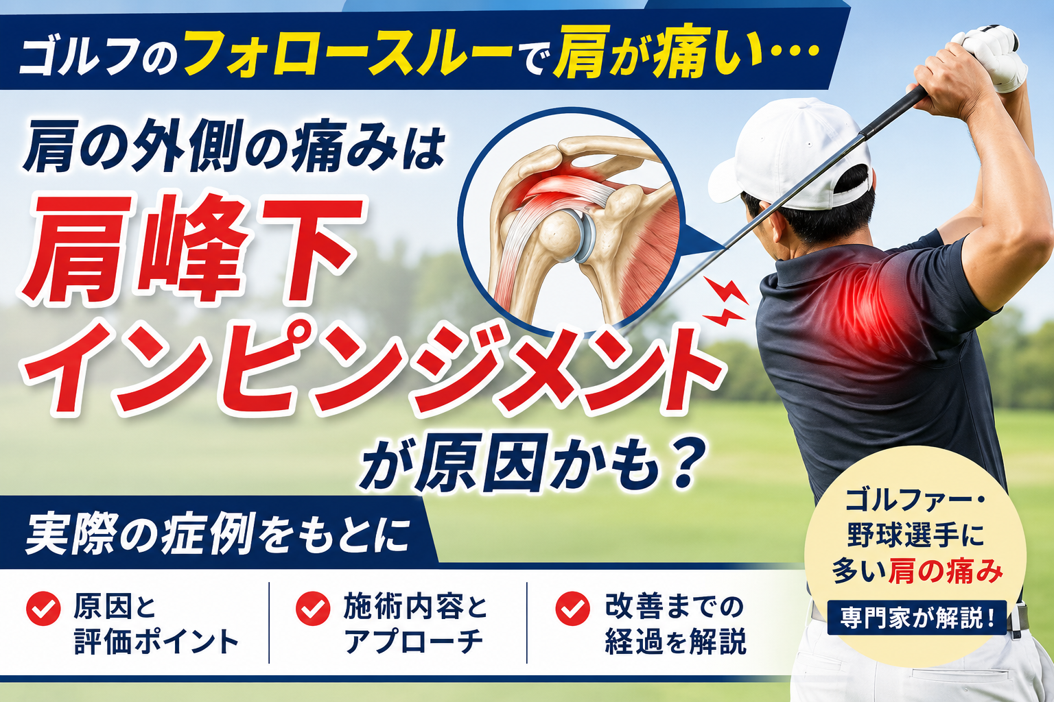 肩峰下インピンジメント